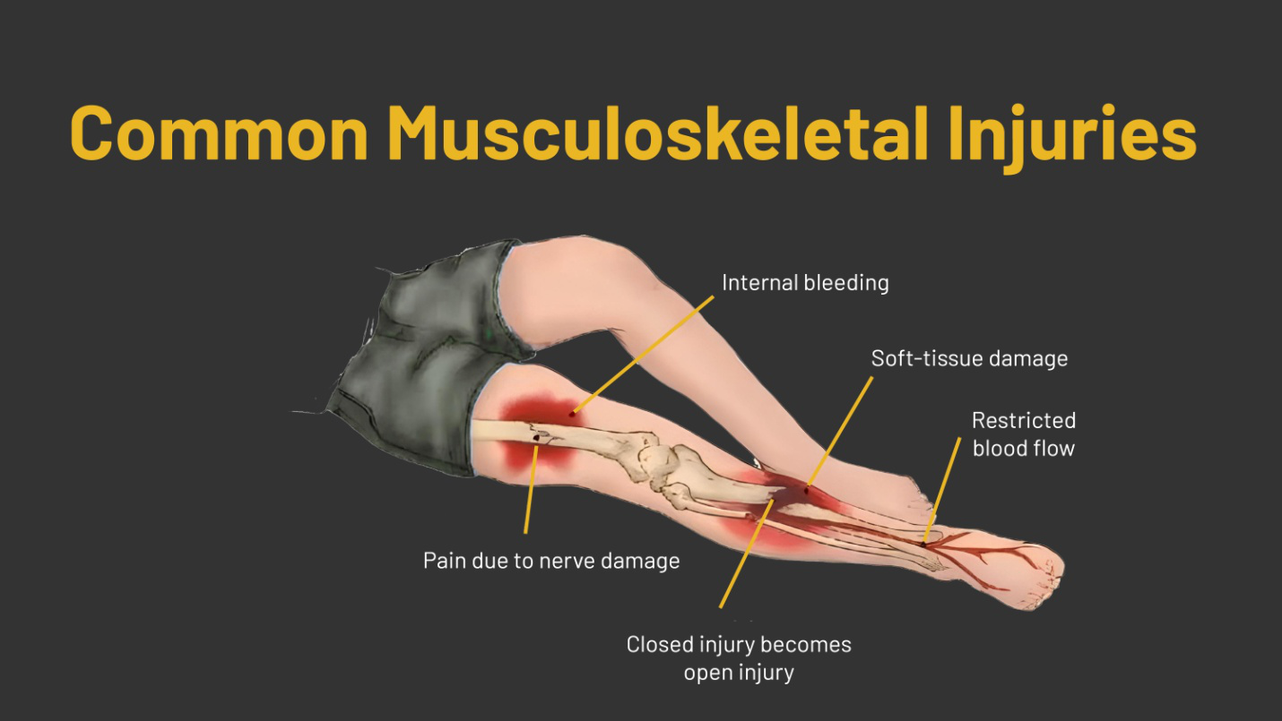 Musculoskeletal Injuries